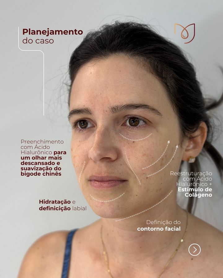 Arte da Dra. Mayara mostrando o planejamento do caso, com preenchimento e bioestimulador de colágeno